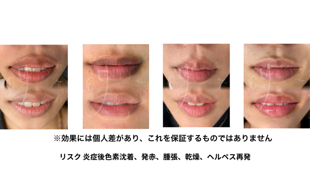 唇のくすみ薬剤除去の施術例 ビフォーアフター写真 長期経過
