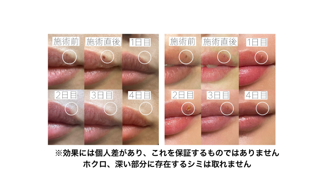 唇シミ薬剤除去 経過 リプアートメイク大阪